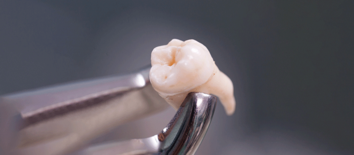 a wisdom tooth after being extracted.