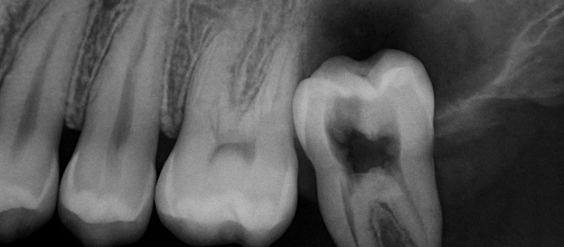 Close up X-Ray of an infected molar with swelling around the gums. No text on the image.