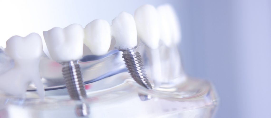 Dentist consulting with a patient about dental implants in a modern clinic