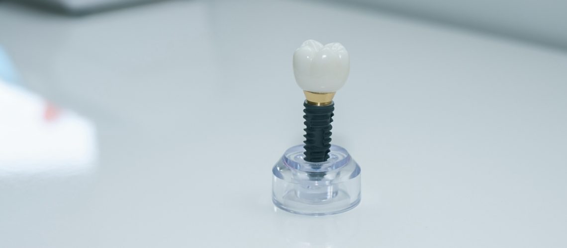 Dentist consulting with a patient about dental implant options in a modern clinic