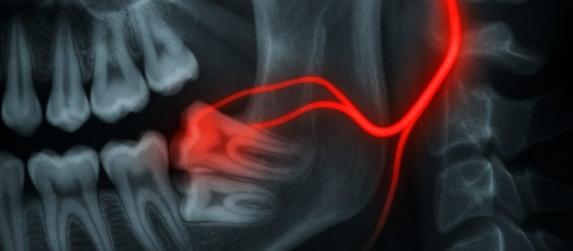 Close up X-ray of impacted wisdom teeth with one pressing against the trigeminal nerve. The nerve is highlighted in bright red, going towards the ear. No text on image.