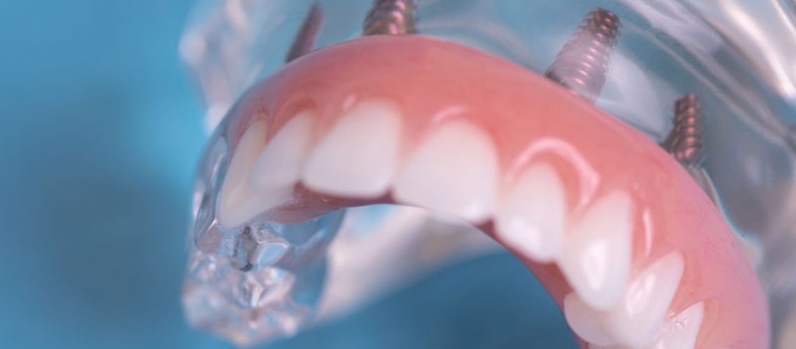 a full mouth dental implant model that can show patients how their smile can be restored with full mouth dental implants after getting their teeth extracted.