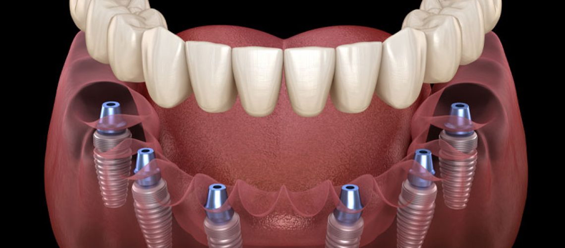 a full mouth dental implant model showing 6 dental implant posts planted in the gum under dental crowns