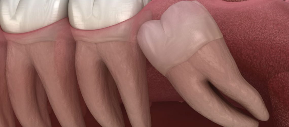 Impacted Wisdom Tooth