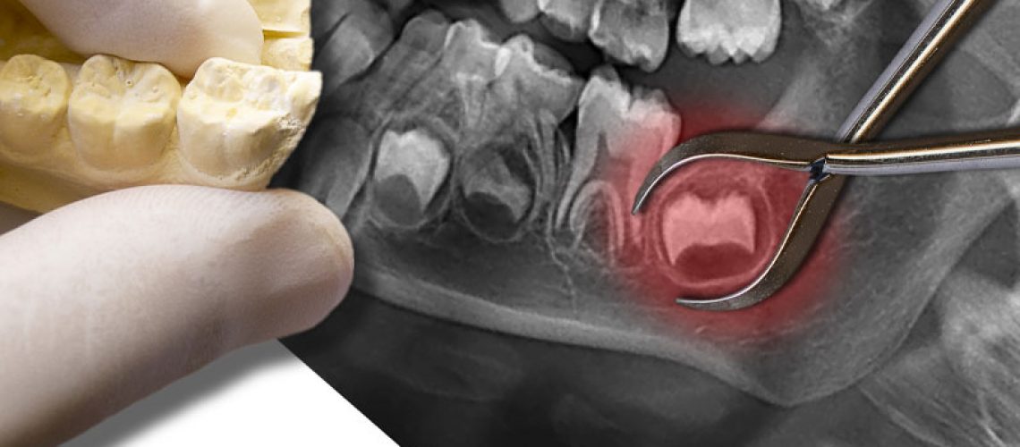 a dental xray showing an impacted wisdom tooth needing to be extracted.