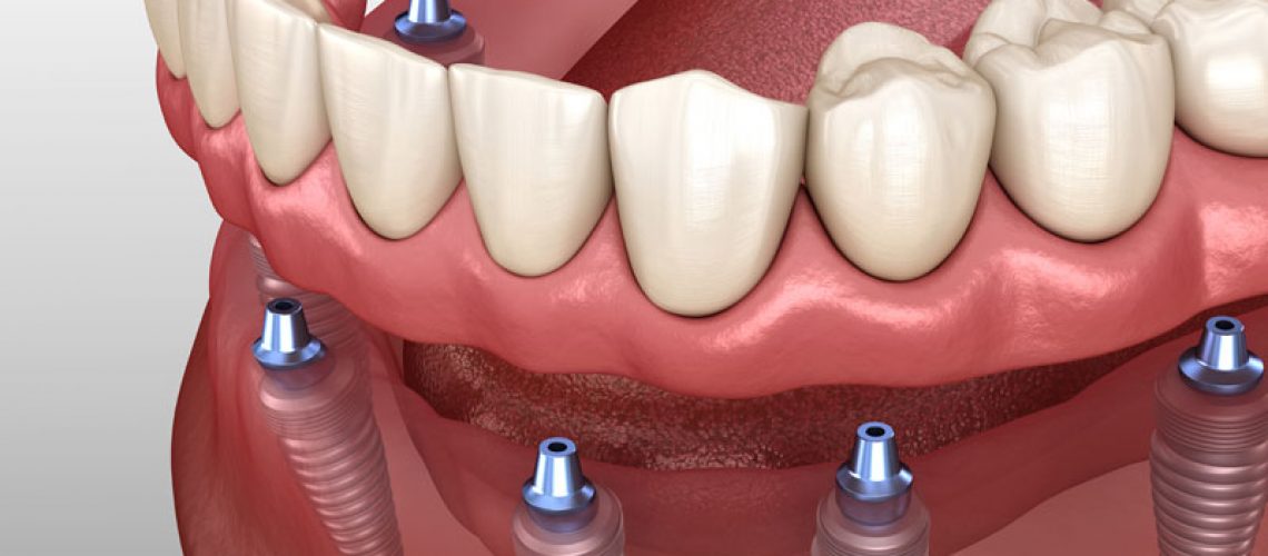 Implant Supported Dentures