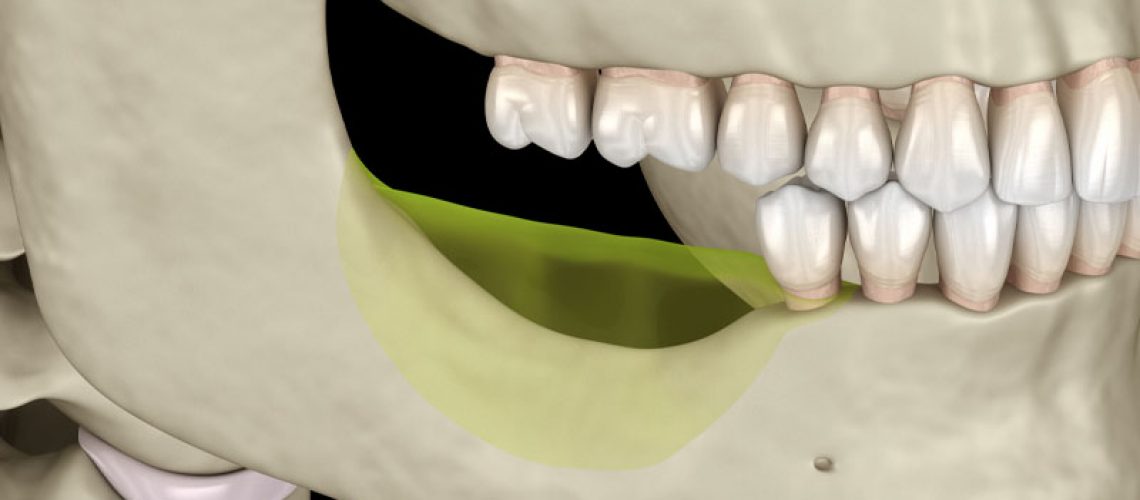 a graphic showing jaw bone loss on the lower jaw