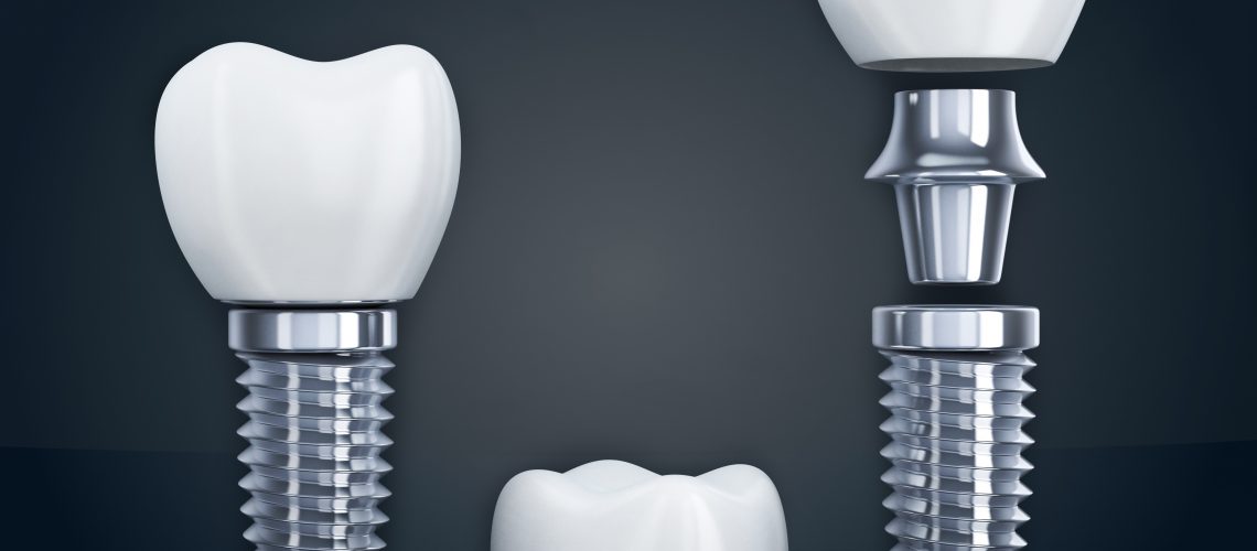 Dental Implant