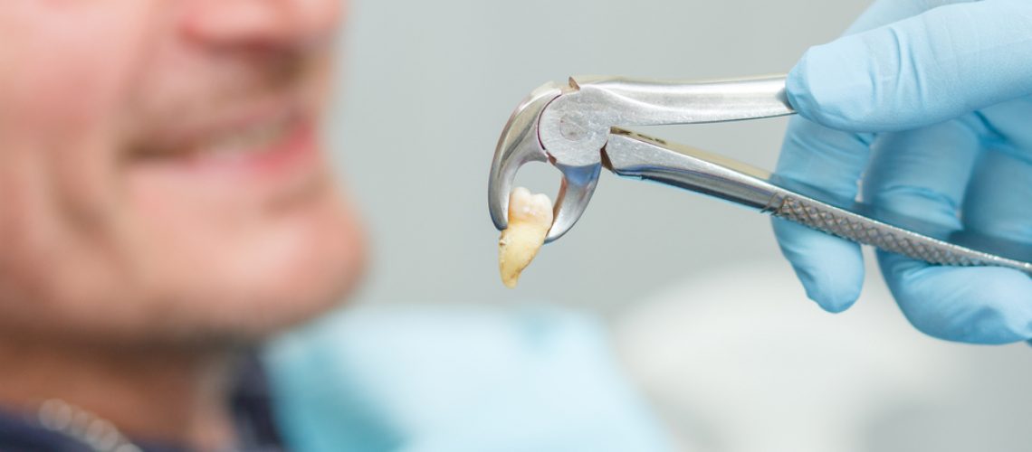 Types of Tooth Extractions