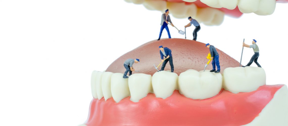 Where Do Dental Implants Come From?