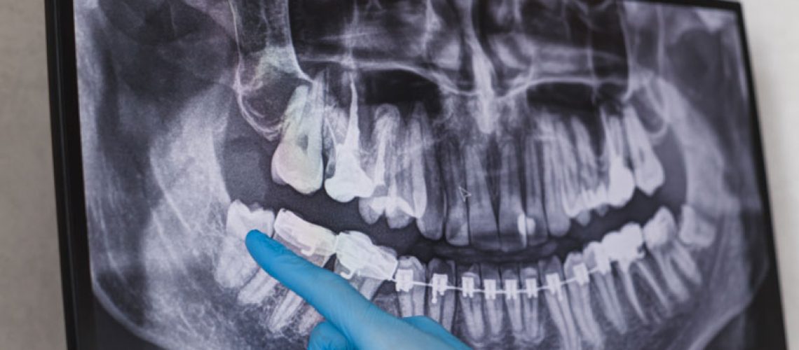 an x-ray image of an impacted wisdom tooth.