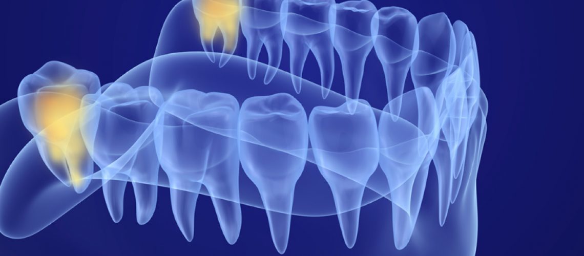 Wisdom tooth x-ray view. Medically accurate tooth 3D illustration.